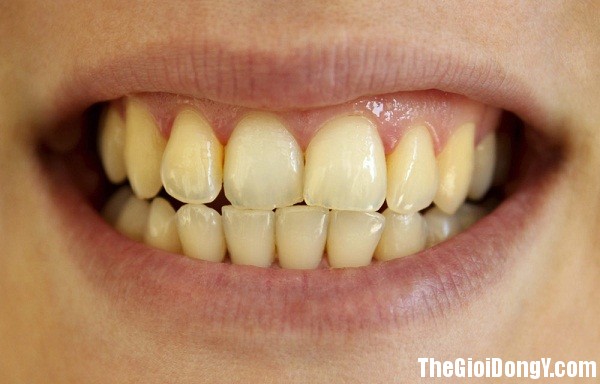photo 0 1490327845412 Một loạt biến chứng nguy hiểm từ việc lười đánh răng