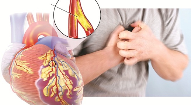 cac benh ve tim Cây thuốc có công dụng hỗ trợ chữa bẹệnh tim mạch hiệu quả