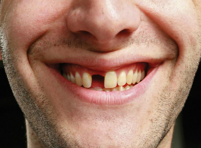 gayrang Y học tiến bộ, răng gãy có thể cắm lại được?