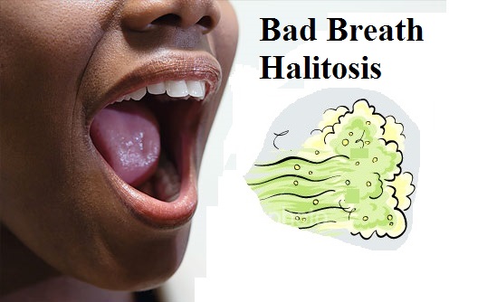 Bad Oral Hygiene Halitosis Những loại bệnh răng miệng thường gặp mà người nào cũng mắc phải