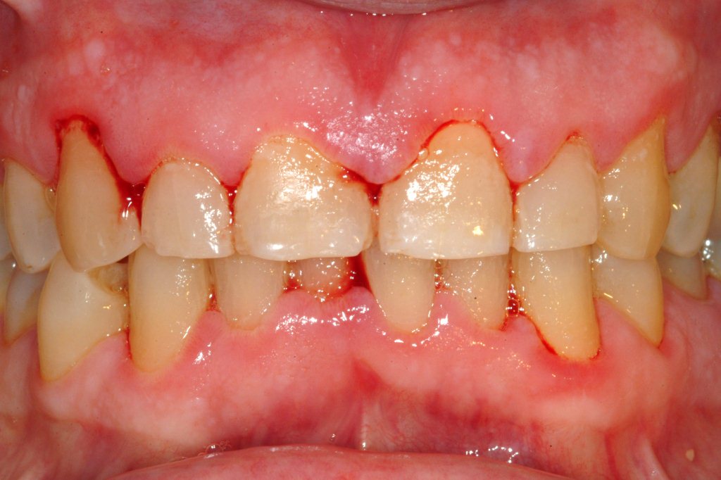 tut loi 1 Những loại bệnh răng miệng thường gặp mà người nào cũng mắc phải