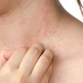 eczema-itch